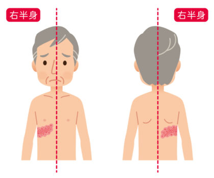 帯状疱疹とは