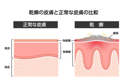 尋常性乾癬とは